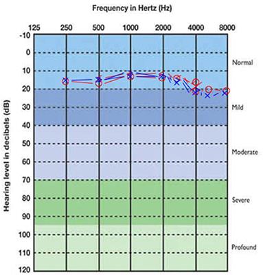 Tinnitus emerging in the context of a COVID-19 infection seems not to differ in its characteristics from tinnitus unrelated to COVID-19